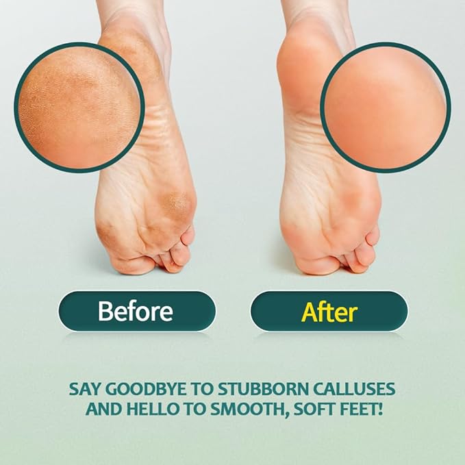Gorgellux Callus Remover Gel, Callus Remover - Image 2