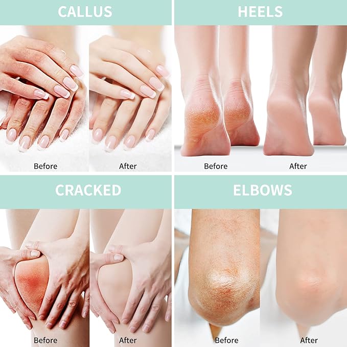 Grocerism 2 Packs Urea Cream 20% Plus 2% Salicylic Acid 5.3oz || Foot Cream - Image 4