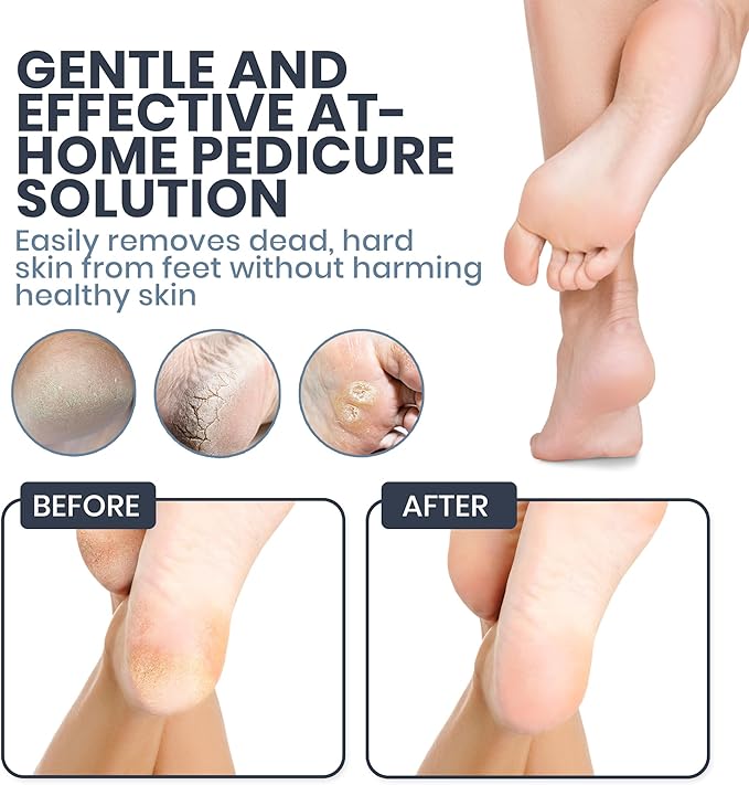 Upgraded 2026 Electric Foot File – Callus Remover - Image 6