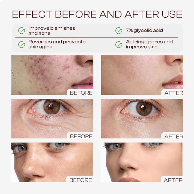Glycolic Acid Toner: 240ml Glycolic Acid 7% Exfoliating Toner Toning Solution - Image 3