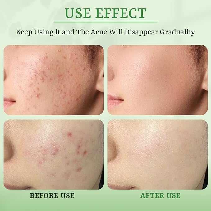 Anti Acne Face Mask Salicylic Acid Face Masks Skincare, Hydrating Face Masks - Image 7