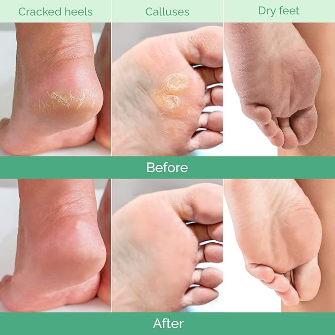 PLANTIFIQUE Foot Peeling Mask 1 Pack | Dermatologically Tested Repairs Heels & - Image 3