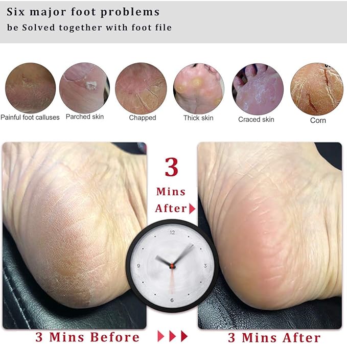 Kinepi Foot File Callus Remover Foot Scrubber, Professional Pedicure Foot Rasp - Image 3