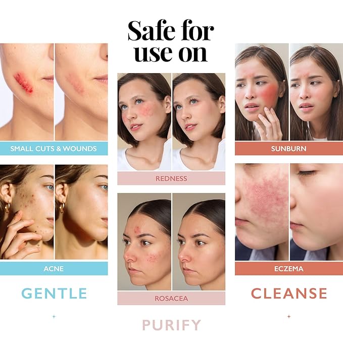 Hypochlorous Acid Spray for Face and Skin; Facial Cleanser | 8oz Face Mist - Image 4