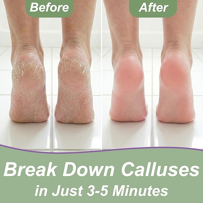 Callus Remover Gel & Double-Sided Foot File: 8 oz Extra Strength Callus Remover - Image 4