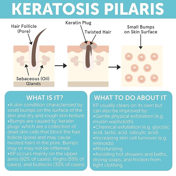 Keratosis Pilaris Treatment | Keratosis Pilaris Lotion - Image 6