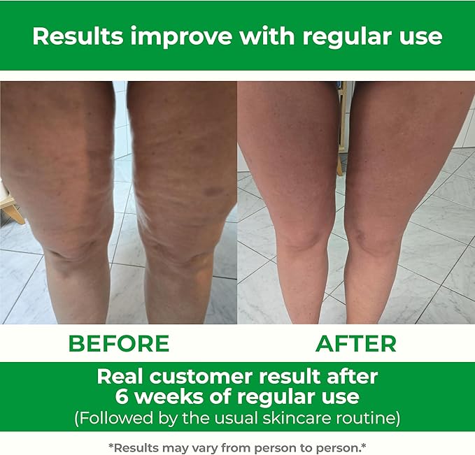 TESMED Cellulite Manual Massager : Made in Italy, Patented - Image 4