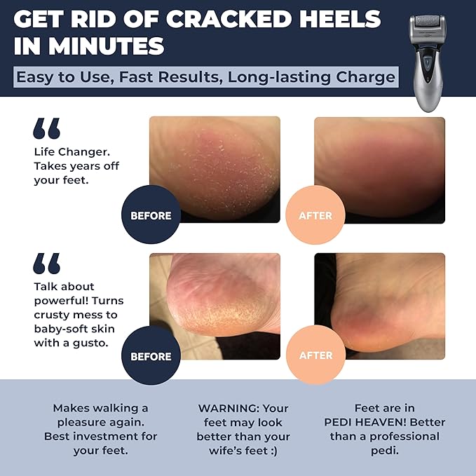 Electric Callus Remover: Rechargeable Electronic Foot File CR900 by Own Harmony - Image 2