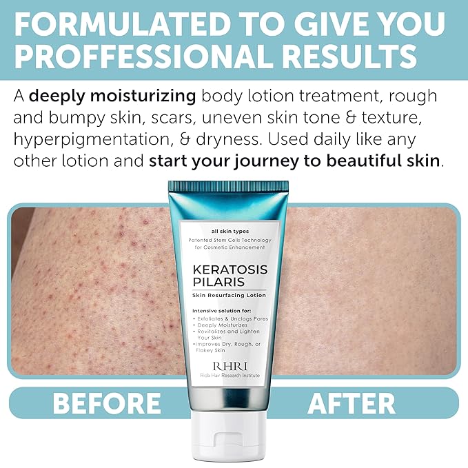 Keratosis Pilaris Treatment | Keratosis Pilaris Lotion - Image 4