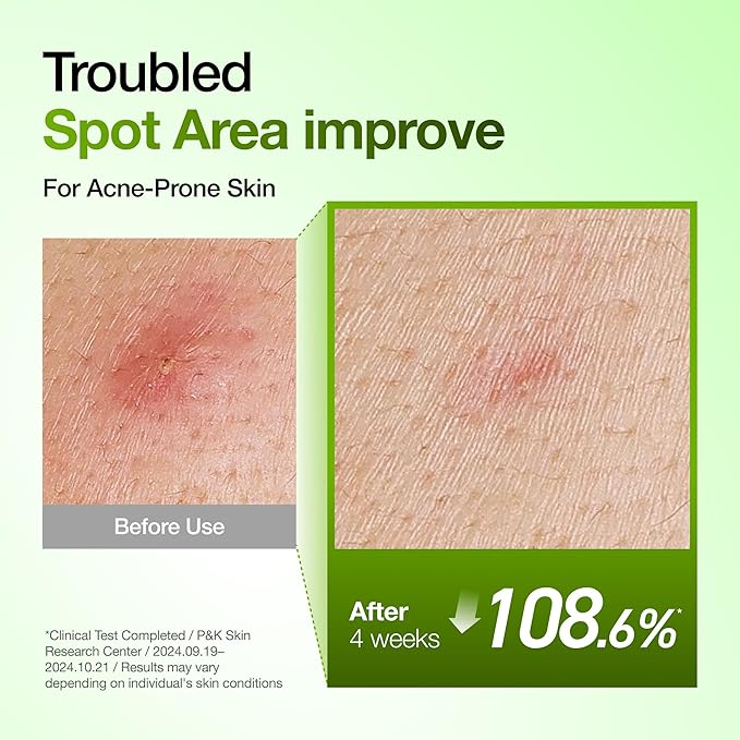 Anua Azelaic Acid 10 Hyaluron Redness Soothing Serum, Facial Serum - Image 4