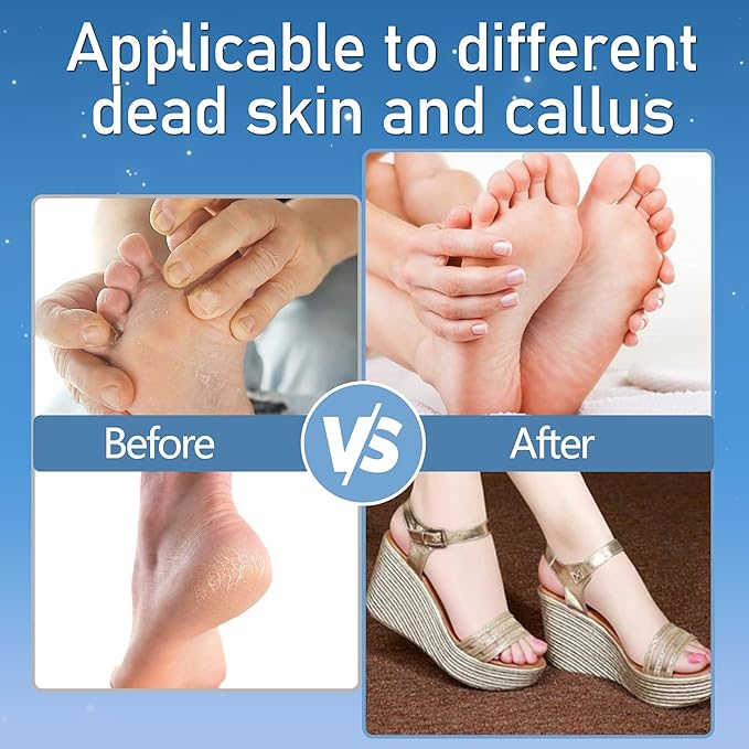 Callus Remover for Feet, Electric Foot Callus Remover Waterproof - Image 4